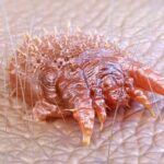Primo piano di un acaro della scabbia ingrandito al microscopio, poggiato sulla superficie della pelle umana.