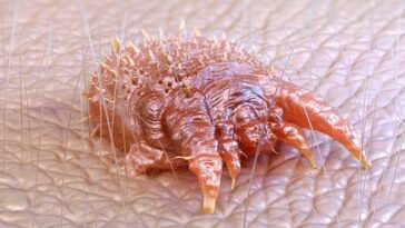 Primo piano di un acaro della scabbia ingrandito al microscopio, poggiato sulla superficie della pelle umana.